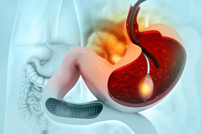 Coil plus glue therapy beneficial for gastric varices