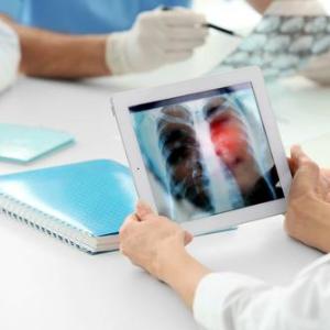 Aumolertinib shows promise in untreated EGFR-variant metastatic NSCLC