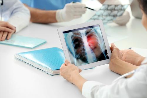 Aumolertinib shows promise in untreated EGFR-variant metastatic NSCLC
