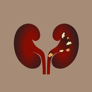 Glucose-lowering med shows promise for treating kidney stones in nondiabetics