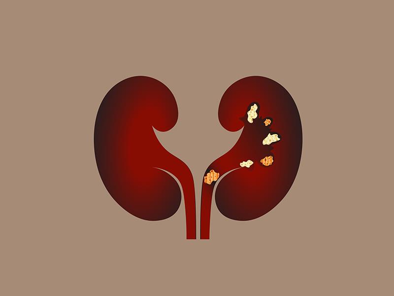 Glucose-lowering med shows promise for treating kidney stones in nondiabetics
