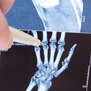 HPV9 vaccination tied to reduced risk of juvenile idiopathic arthritis