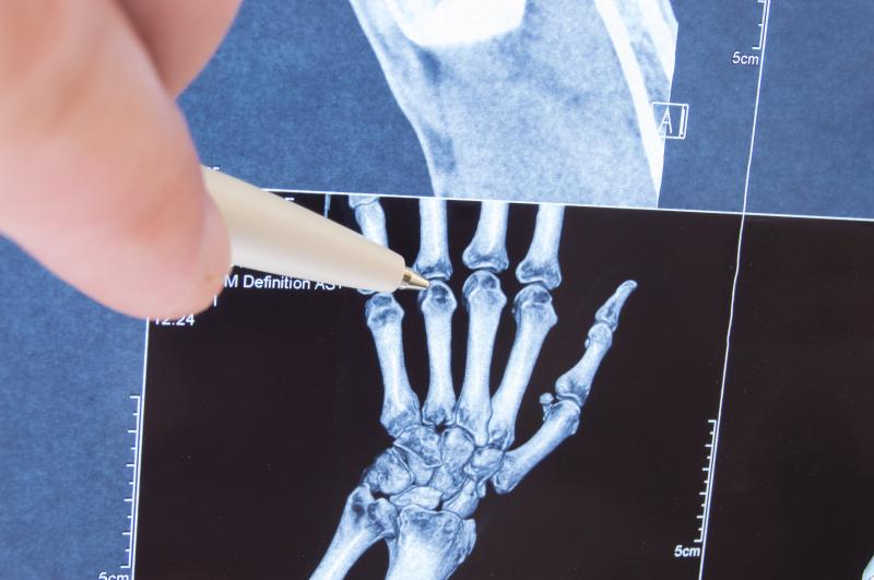 HPV9 vaccination tied to reduced risk of juvenile idiopathic arthritis