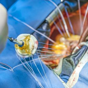 Partial heart transplant safe, feasible in congenital heart disease