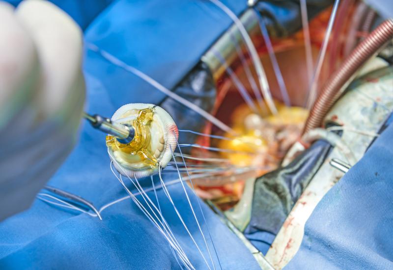 Partial heart transplant safe, feasible in congenital heart disease