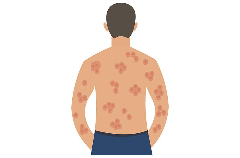 Among adults receiving adalimumab treatment, those with hidradenitis suppurativa appear to be at greater risk of infection th