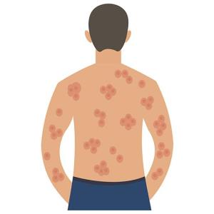 Chronic medical, psychiatric comorbidities common in paediatric hidradenitis suppurativa