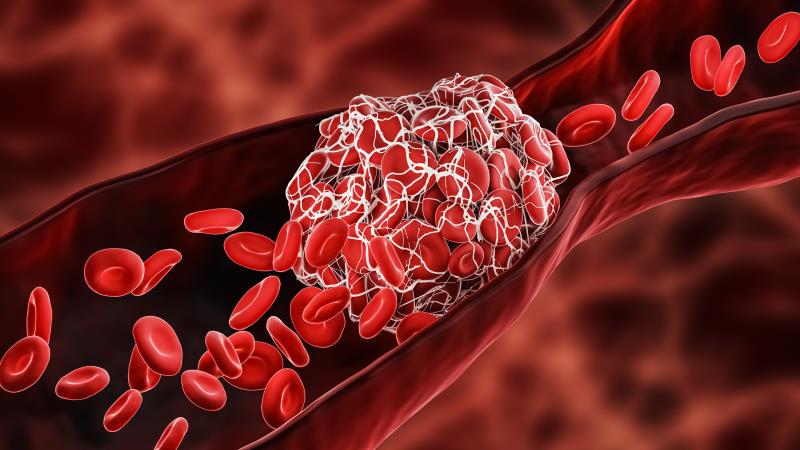 Prediction models show poor accuracy in stratifying VTE risk in patients