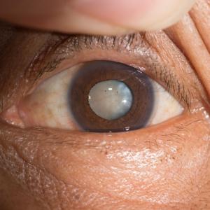 Cataracts may raise risk of fractures