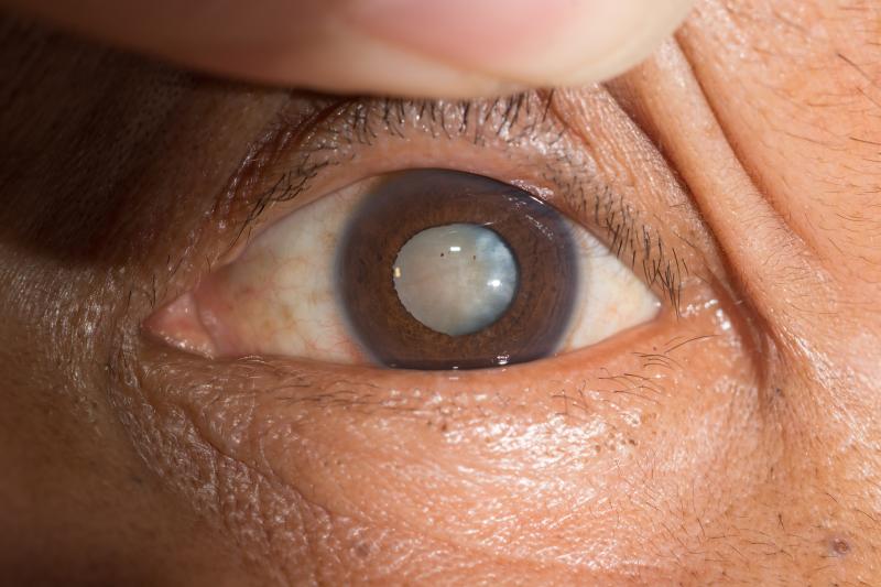 Cataracts may raise risk of fractures