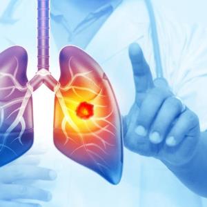 Real-world insights: Transforming NSCLC treatment with a modified anti–PD-1 antibody