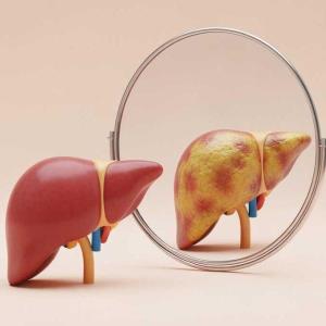 HK studies: SGLT2i reduce liver fat in nondiabetic MASLD, lower HCC risk in T2D + CHB