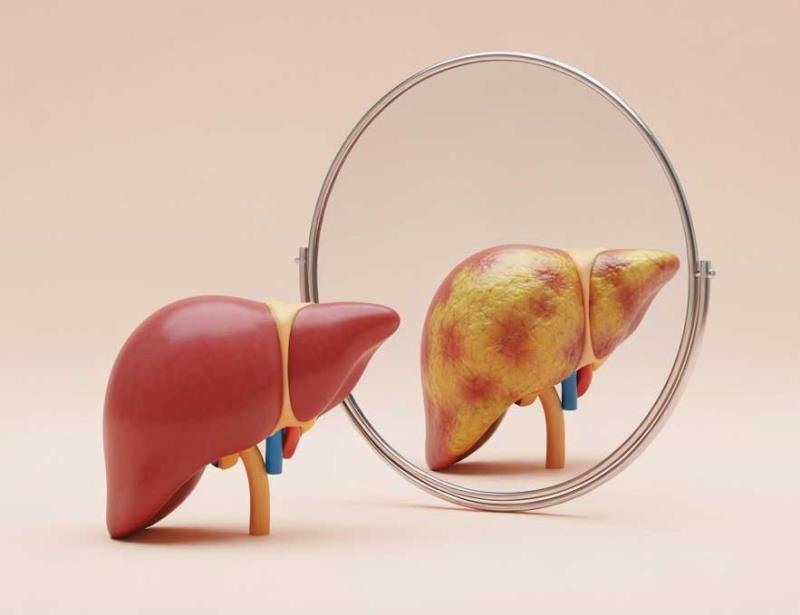 <p style="line-height: 115%;"><span>Metabolic dysfunction&ndash;associated steatotic liver disease (MASLD) can lead to the de