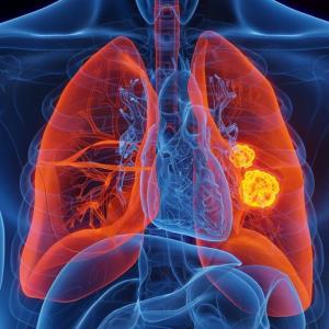 Advances in ROS1-positive NSCLC treatment landscape