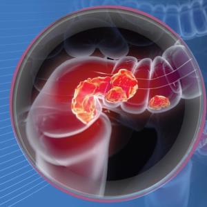 Timely rectal cancer treatment extends survival outcomes