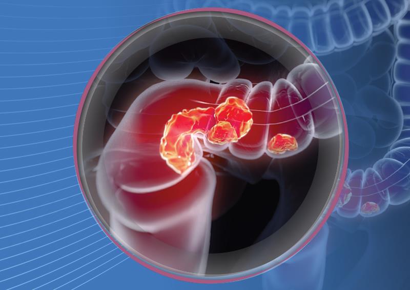 Timely rectal cancer treatment extends survival outcomes