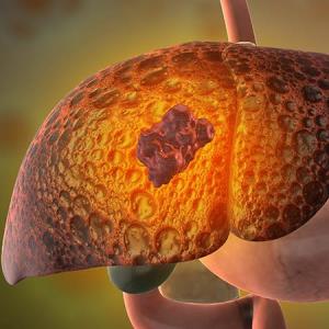 Irpagratinib plus atezolizumab combo active against FGF19+ HCC