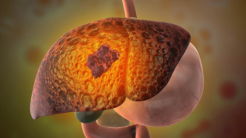 Irpagratinib plus atezolizumab combo active against FGF19+ HCC
