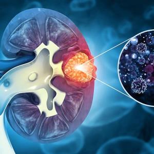 Sintilimab plus axitinib shows therapeutic potential in FH-deficient RCC