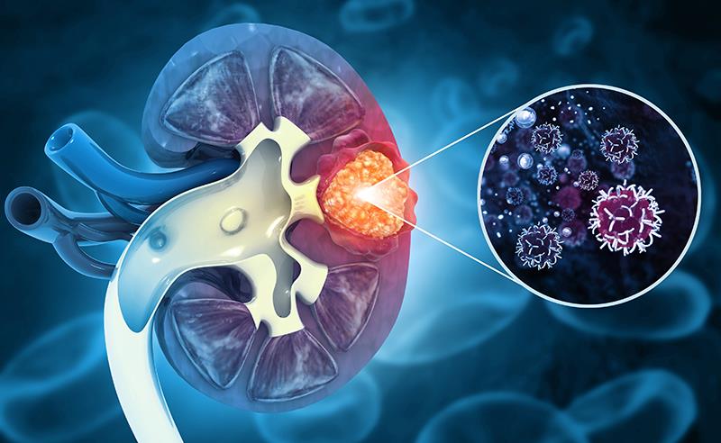 Sintilimab plus axitinib shows therapeutic potential in FH-deficient RCC