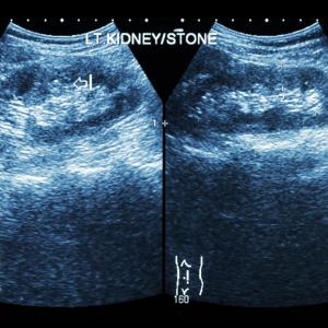 Ultrasonic propulsion clears residual stone fragments in kidney