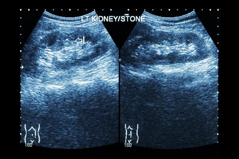 Ultrasonic propulsion clears residual stone fragments in kidney