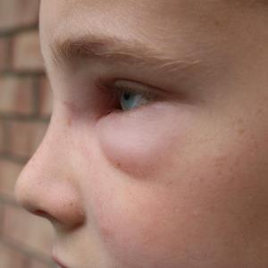 Berotralstat shows promise in preventing hereditary angioedema attacks