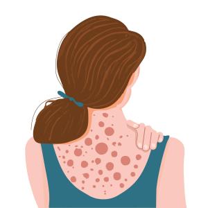 Pooled data support ruxolitinib cream for treating prurigo nodularis