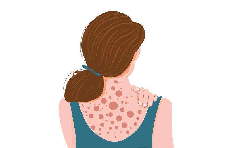 Pooled data support ruxolitinib cream for treating prurigo nodularis