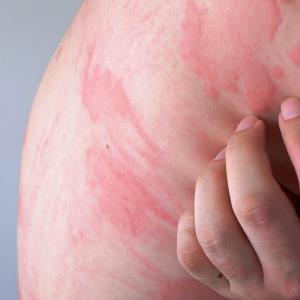 Rilzabrutinib for H1-antihistamines-refractrory CSU clears phase II trial