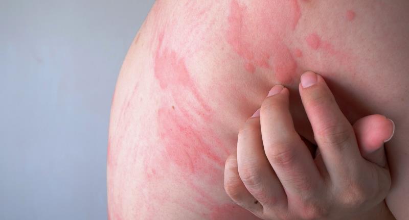 Rilzabrutinib for H1-antihistamines-refractrory CSU clears phase II trial