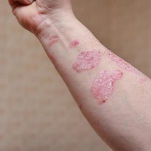 Long-term bimekizumab delivers durable efficacy in plaque psoriasis