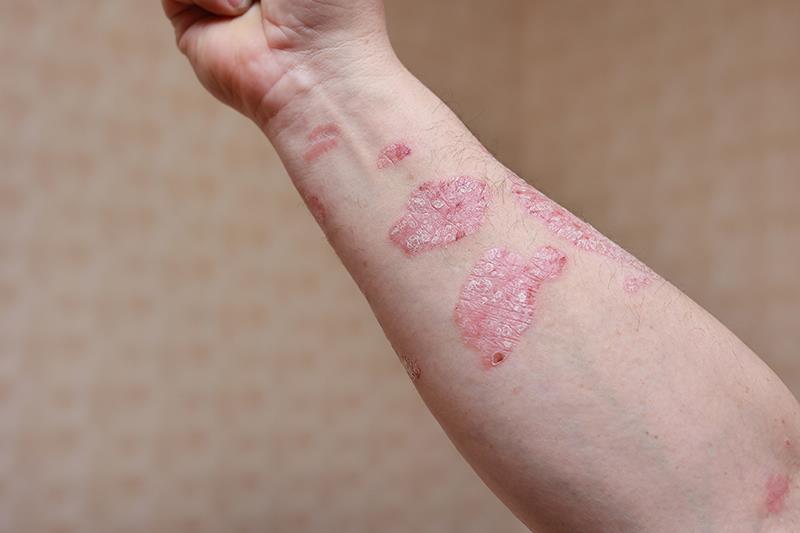 Long-term bimekizumab delivers durable efficacy in moderate-to-severe plaque psoriasis