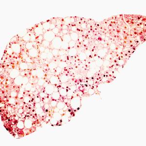 MASLD severity tied to poor cognitive function, HRQoL in patients with obesity