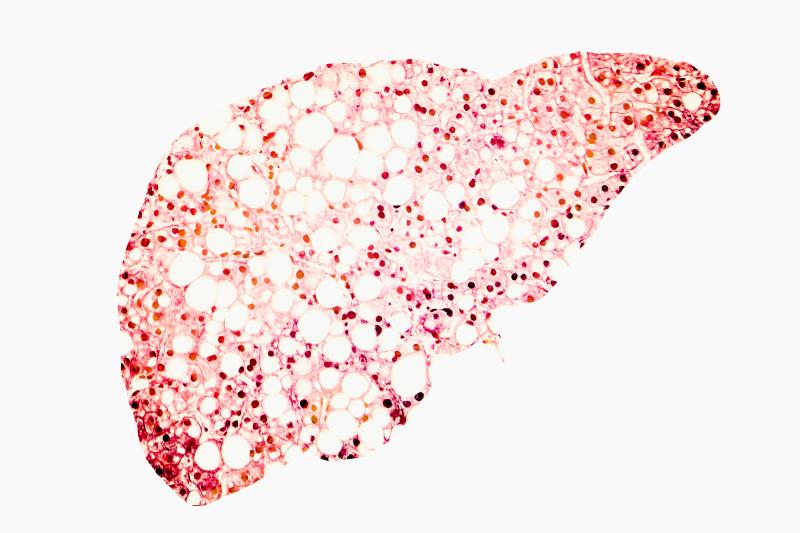 MASLD severity tied to poor cognitive function, HRQoL in patients with obesity