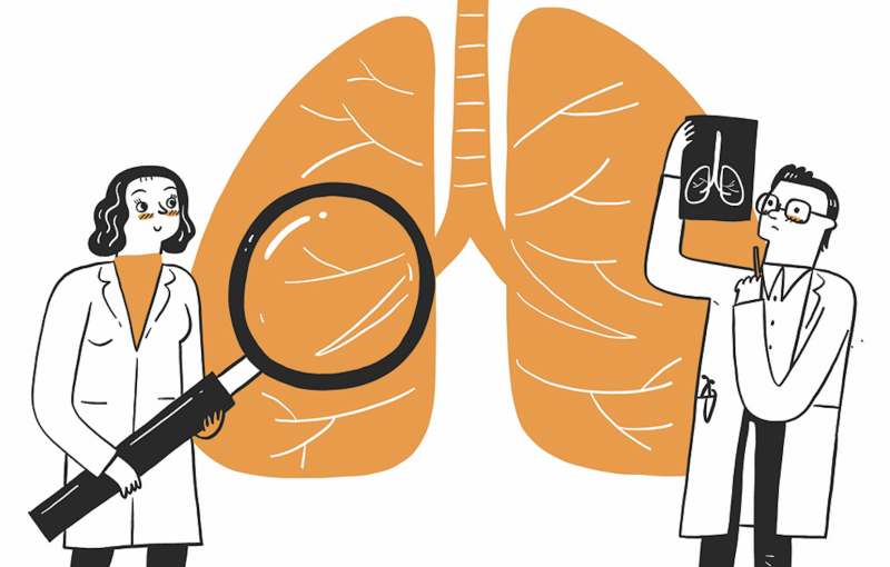 Lung nodule surveillance programme helps detect early-stage lung cancer