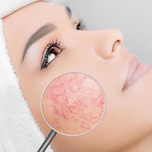 Modified minocycline hydrochloride formulation works against papulopustular rosacea