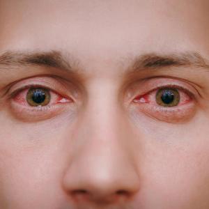 Uveitis risk reduced with GLP-1RAs