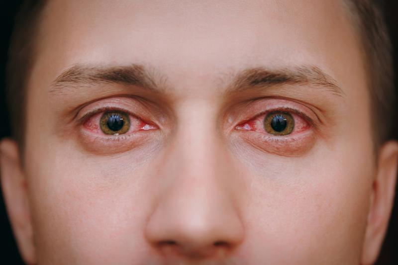 Uveitis risk reduced with GLP-1RAs