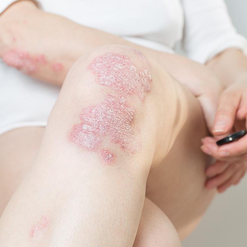 BMI, CCI linked to biologic response in psoriasis patients