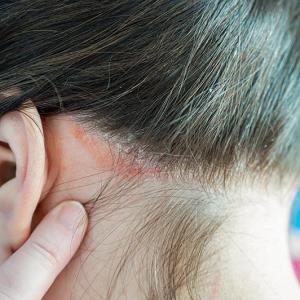 Once-daily roflumilast foam may bring relief in psoriasis