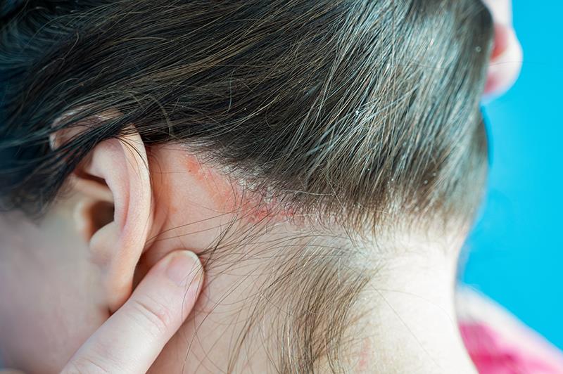 Once-daily roflumilast foam may bring relief in psoriasis