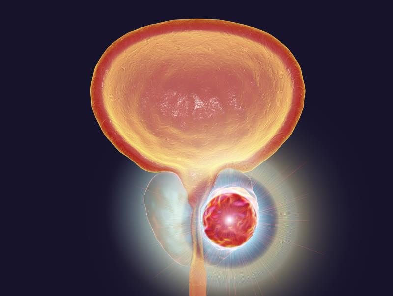 Cabozantinib plus atezolizumab improves PFS in mCRPC after progression on ARPI