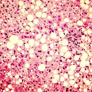 Icosabutate shows potential as treatment for MASH