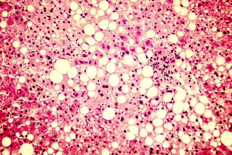 Icosabutate shows potential as treatment for MASH