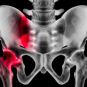 Testosterone offers no long-distance mobility benefit to women with hip fracture