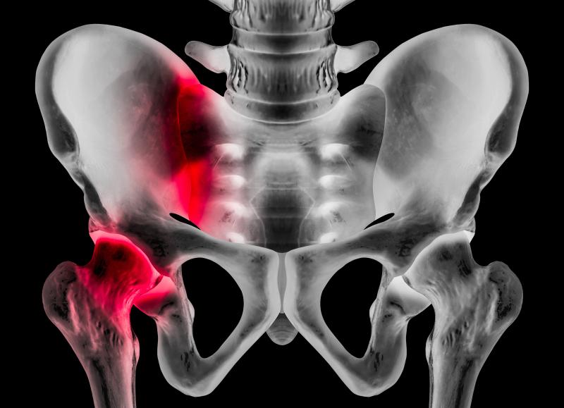 Testosterone offers no long-distance mobility benefit to women with hip fracture