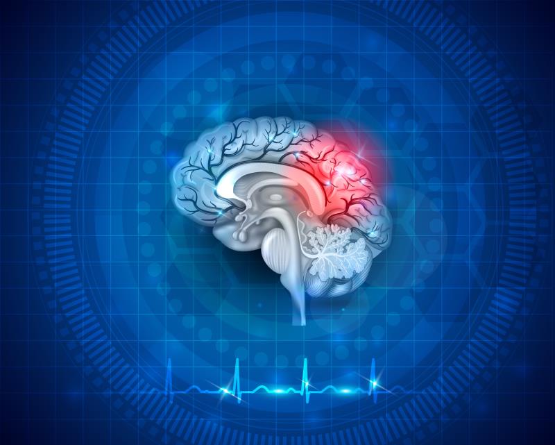 Residual recurrence risk high after AF-related stroke