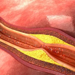 Elevated serum uric acid tied to high-risk coronary artery plaques