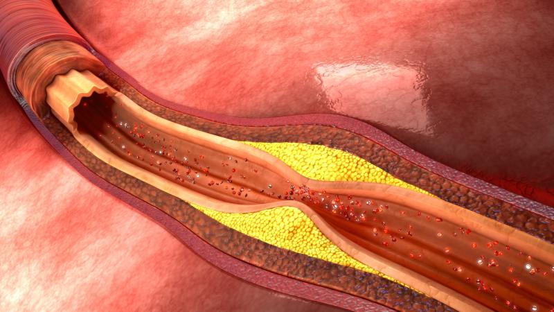 Elevated serum uric acid tied to high-risk coronary artery plaques